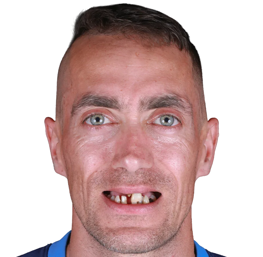 Invisalign - Öncesi