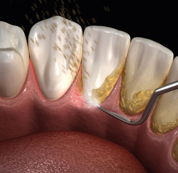 Does scaling damage your teeth?